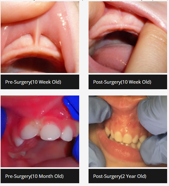 infant frenecetomy